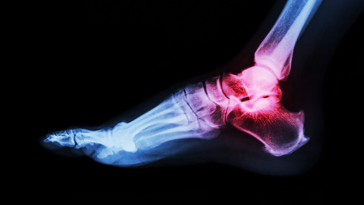 An X-ray of a foot and ankle